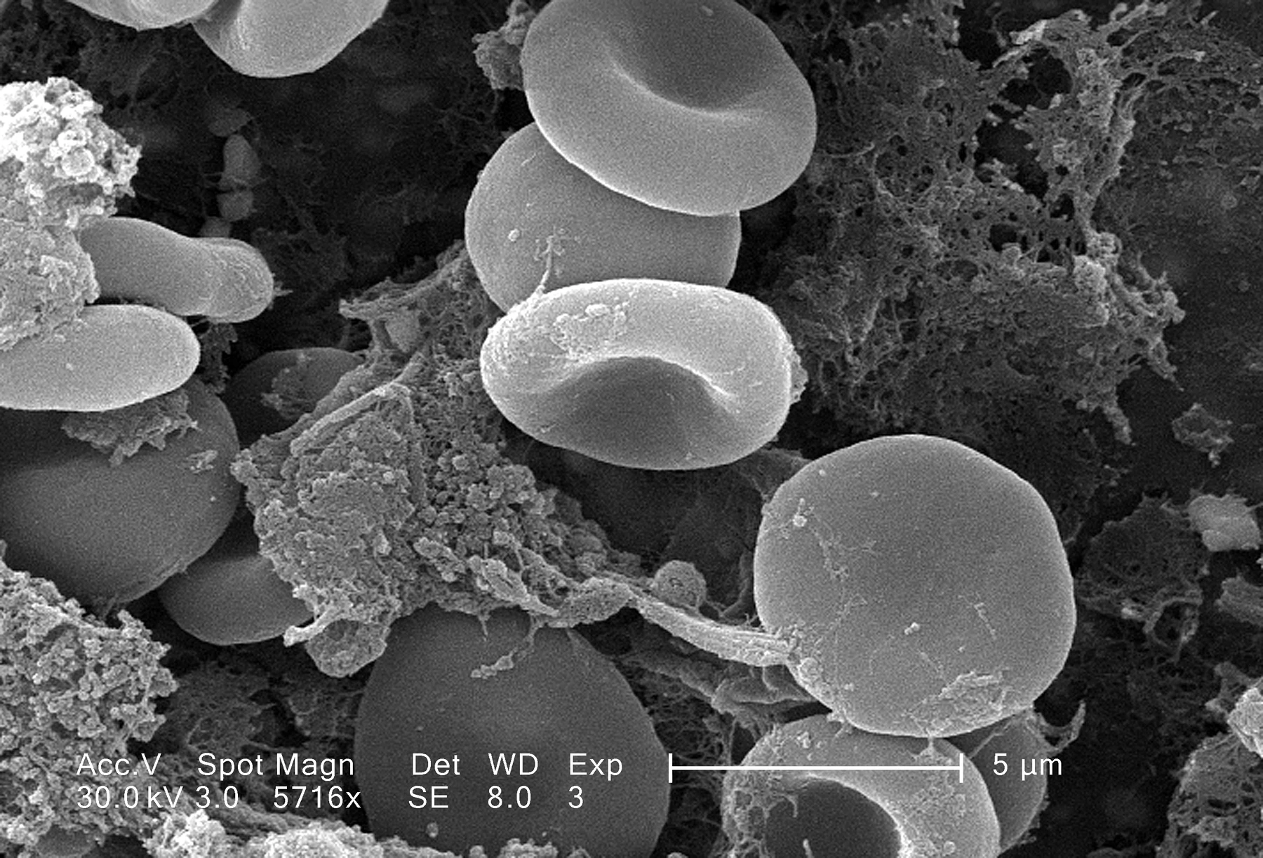 Grayscale SEM of biconcave red blood cells in fibrin, with SEM settings and a five micrometer scale bar along the bottom